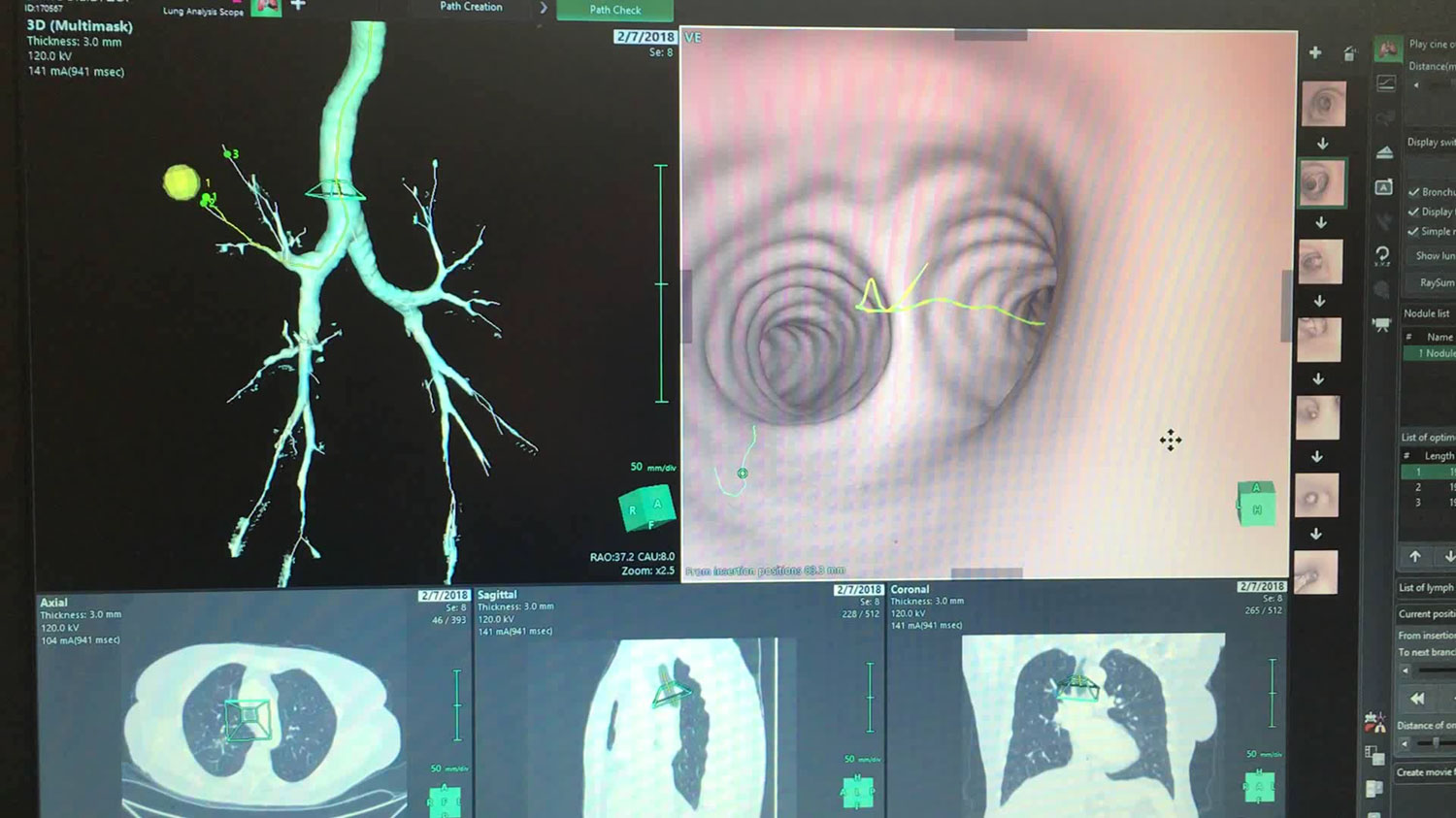 Navigation bronchoscopy