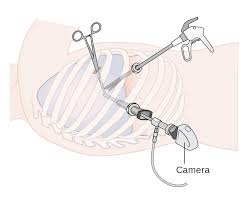 Thoracoscopy